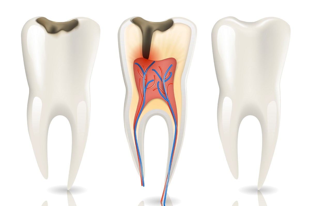 Lechenie-pulpita-molochnyh-zubov